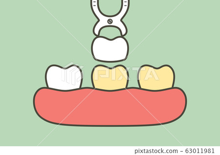 dental veneers installation procedure for tooth whiten 63011981