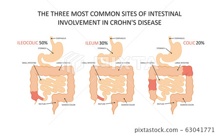 Three most common sites of intestinal involvement in crohn's disease Three most common sites of intestinal involvement in crohn's disease 63041771
