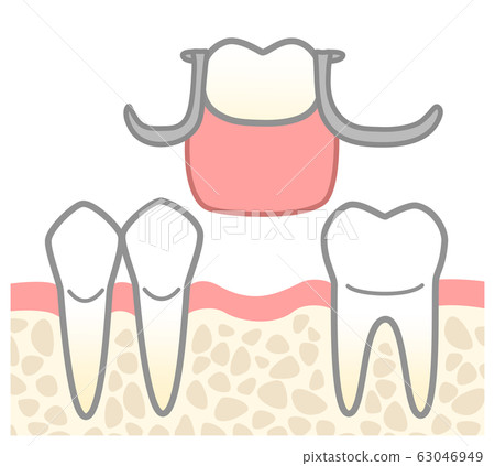 Partial dentures Illustrated How to insert Wire tightly Partial dentures Illustrated How to insert Wire tightly 63046949