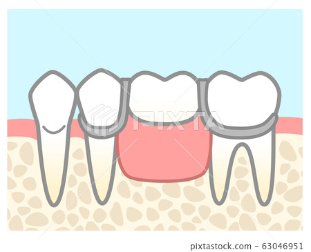 Partial denture illustration wire firmly background Partial denture illustration wire firmly background 63046951