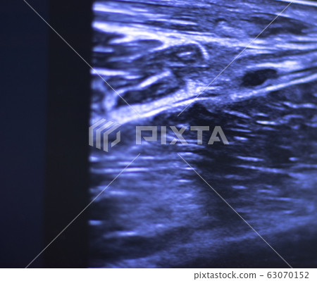EPI dry needling ultrasound scan EPI dry needling ultrasound scan 63070152