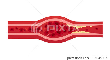 blocked blood vessel artery with cholesterol buildup cells creating blockage in artery thrombosis medical concept horizontal 63085984
