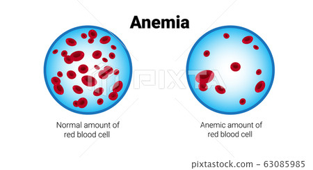 Anemia