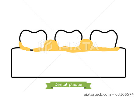 dental plaque or tartar, cause of tooth periodontal disease dental plaque or tartar, cause of tooth periodontal disease 63106574
