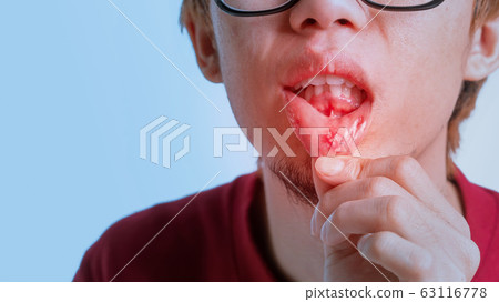 Asian man have aphthous ulcers on mouth on white Asian man have aphthous ulcers on mouth on white 63116778
