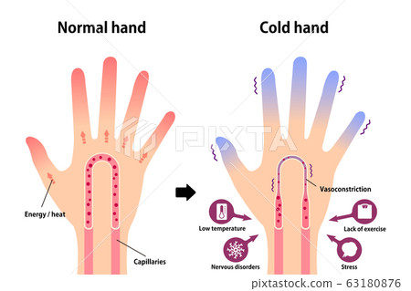 普通手和手有冷端的比較插圖(感冒的原因)/英文 普通手和手有冷端的比較插圖(感冒的原因)/英文 63180876