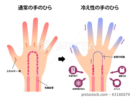 正常手和冷端手的比較(感冒) 正常手和冷端手的比較(感冒) 63180879