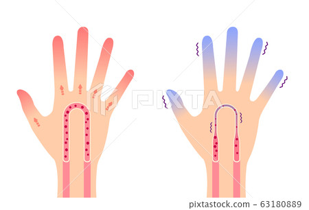 Normal hand and hand with cold end comparison illustration (cause of cold) / no text 63180889