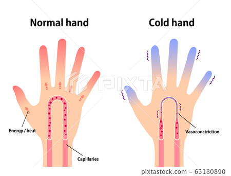 Normal hand and hand with cold end comparison illustration (cause of cold) / English 63180890