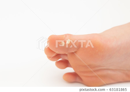 Toe trouble 63181865