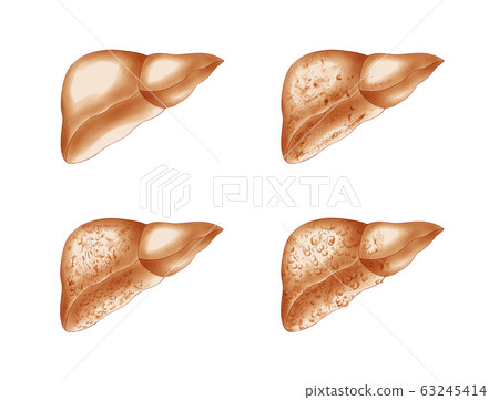 Liver disease progression 63245414