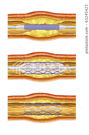 Anatomy of the vascular procedure - Stock Illustration [63245423] - PIXTA