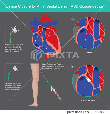 Devices Closure for Atrial Septal Defect. Explain 63248855