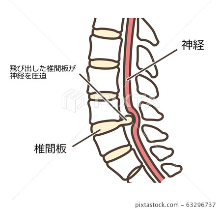 Spine illustration herniated disc with text up Spine illustration herniated disc with text up 63296737