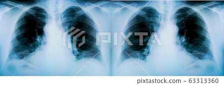 Set of X-ray of a patient's lungs with pronounced traces of the inflammatory process 63313360