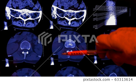 Doctor studying MRI of the lumbar spines bones of the human vertebral column. Spondylodiscitis. Chronic back pain. 63313614