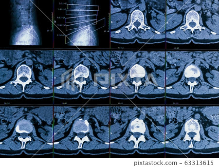 Results of computer tomography or CT imaging of human spine of a patient with chronic back pain, shows degenerative changes of spines, lumbar discs herniation and nerve roots compression 63313615