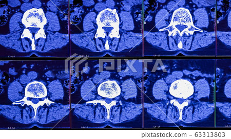 Magnetic resonance imaging of a patient spine with chronic back pain. The MRI shows degenerative changes of spines, lumbar discs herniation and nerve roots compression. Magnetic resonance imaging of a patient spine with chronic back pain. The MRI shows degenerative changes of spines, lumbar discs herniation and nerve roots compression. 63313803