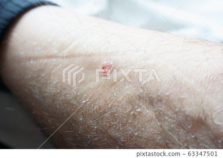 psoriasis 63347501