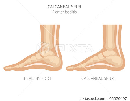 Calcaneal spur. Plantar fasciitis set. Medical 63370497