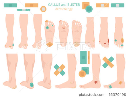 Callus, corn and blister feet and hands. 63370498