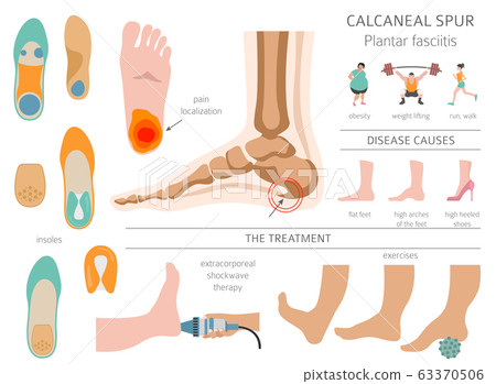 Calcaneal spur. Plantar fasciitis set. Medical 63370506