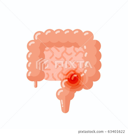 Flat vector illustration of sick human intestine, cartoon style illustration Flat vector illustration of sick human intestine, cartoon style illustration 63401622