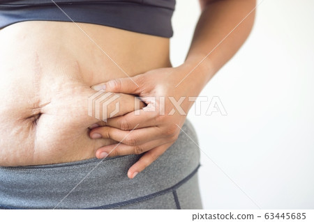 Obese women want to lose weight Obese women want to lose weight 63445685