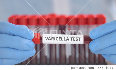 Laboratory assistant wearing protection gloves holds vial with varicella test Laboratory assistant wearing protection gloves holds vial with varicella test 63501045