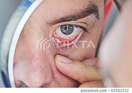 Closeup of human eye that is red and irritated. Symptom of dry eyes Closeup of human eye that is red and irritated. Symptom of dry eyes 63502522
