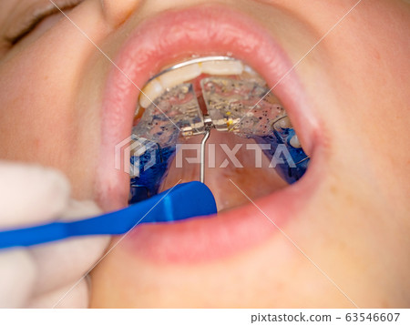 Doctor setting  with tool of palatal brace 63546607