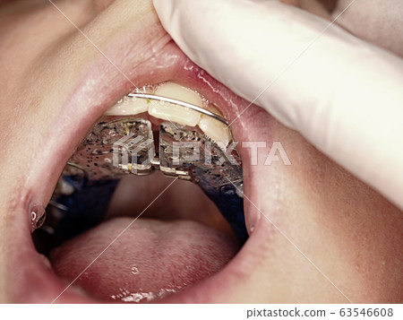 Boy and orthodontist inserting ligatures, Boy and orthodontist inserting ligatures, 63546608