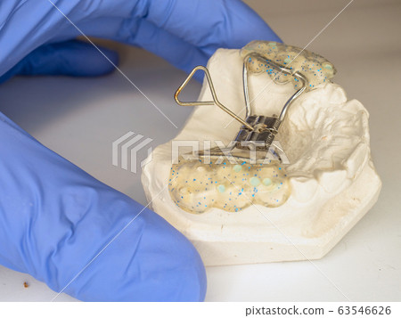 Teeth gypsum model with Hyrax Expander braces 63546626