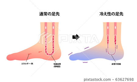 正常腳和冷端腳的比較(感冒) 正常腳和冷端腳的比較(感冒) 63627698