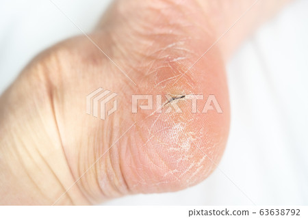 Foot heel crack 63638792
