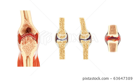膝關節解剖和關節炎進展 插圖素材 圖庫