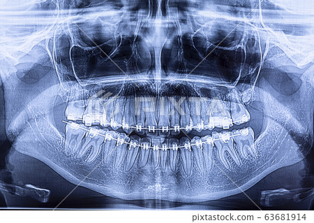 Dental radiography with braces Dental radiography with braces 63681914