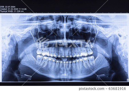 Dental radiography with braces Dental radiography with braces 63681916