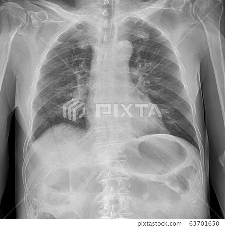 X-ray image of lung with pneumonia 63701650
