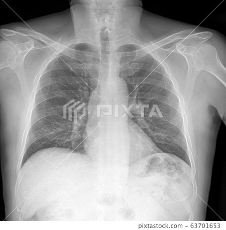 X-ray image of lung with pneumonia 63701653