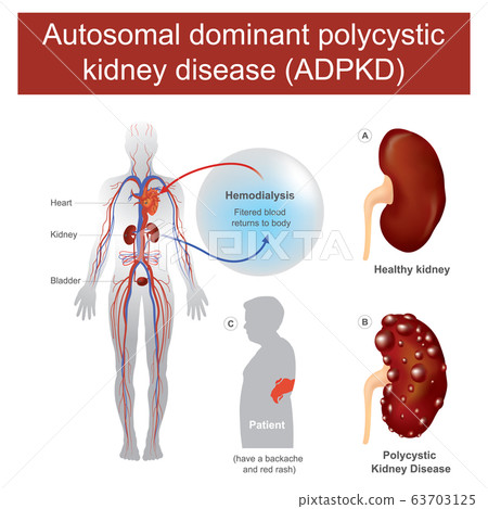 Autosomal dominant polycystic kidney disease. Have 63703125