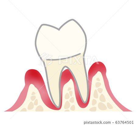 牙齒嚴重牙周炎 插圖素材 圖庫