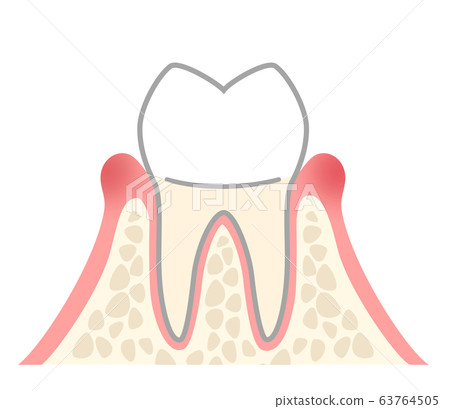 牙齦炎 插圖素材 圖庫