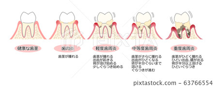 牙周疾病圖和帶有註釋的文本 63766554