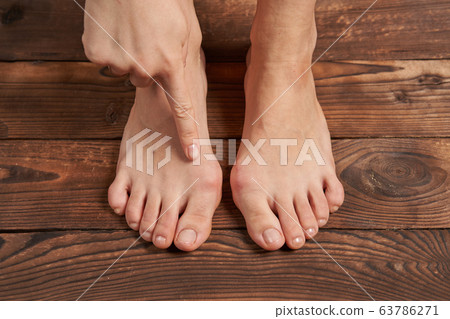Hllux Valgus on female legs close up on wooden 63786271