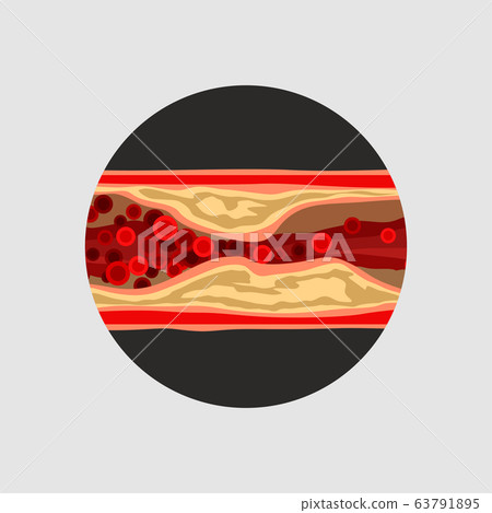 artery with blood cells desease 63791895
