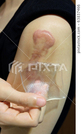 Hand peeling off a silicone gel sheet away from a red keloid scar on the arm. 63837466