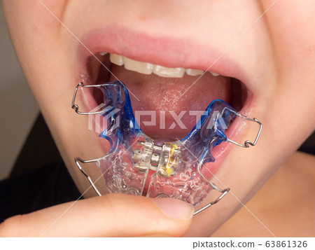 Funny teenager wearing orthodontic braces 63861326