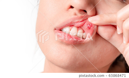 Asian women have aphthous ulcers on mouth on white Asian women have aphthous ulcers on mouth on white 63868471