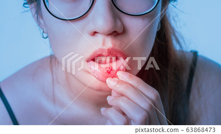 Asian women have aphthous ulcers on mouth, Asian women have aphthous ulcers on mouth, 63868473